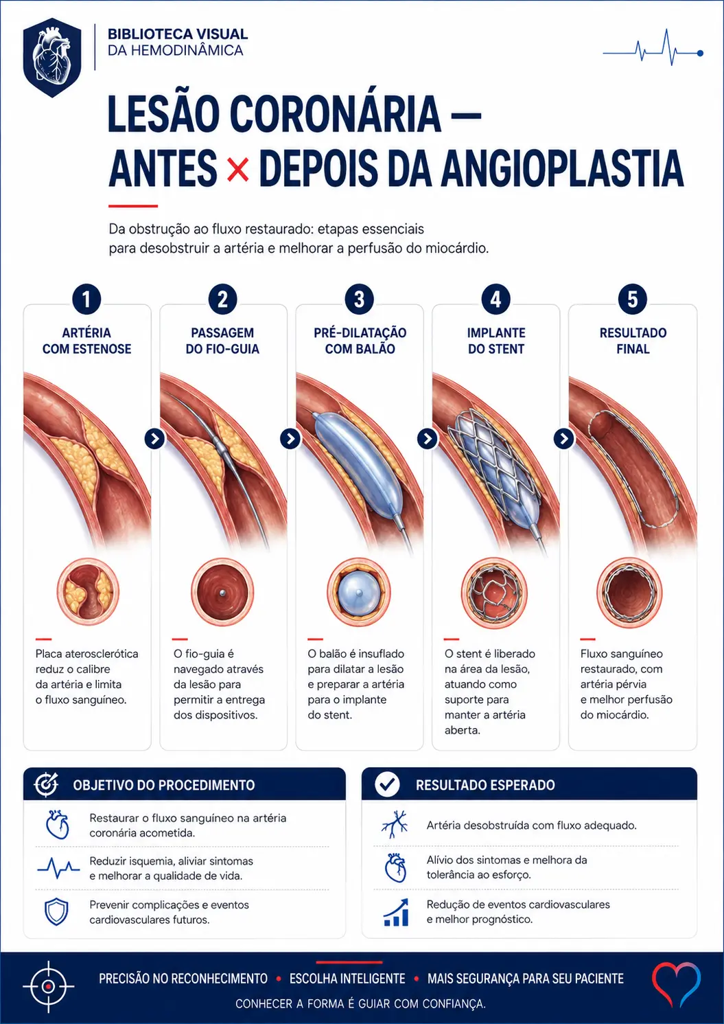 Lesão coronária — antes e depois da angioplastia